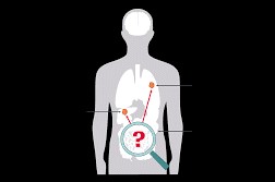 Enhancing Referral and Management of MUO/CUP Patients